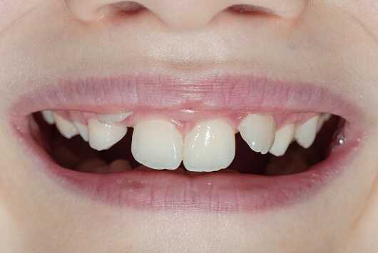 שיניים עקומות