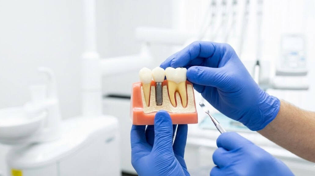 החלפת שתלים בשיניים