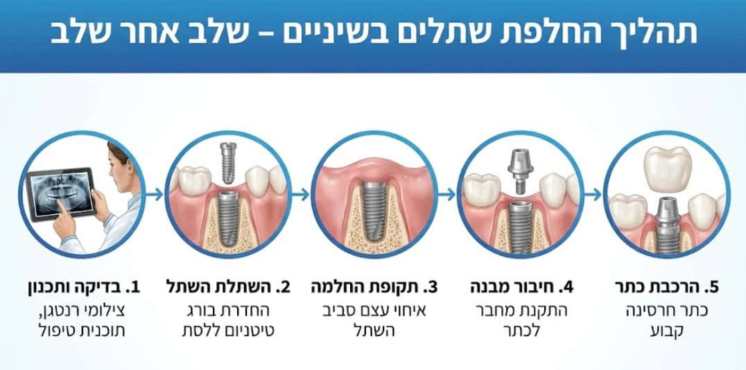 תהליך של החלפת שתלים צעד אחרי צעד