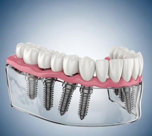 השתלת שיניים בכל הפה