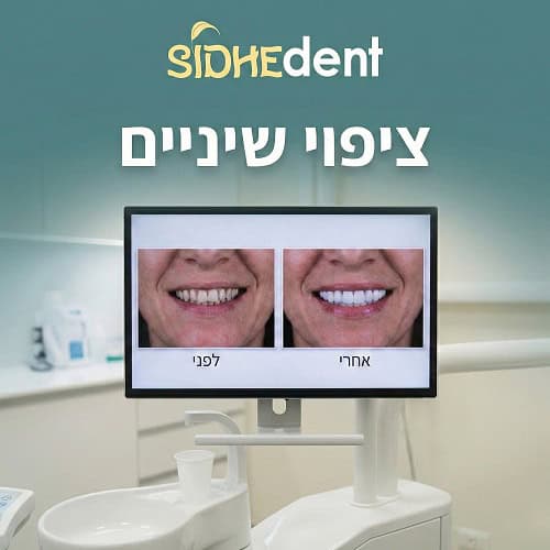ציפוי שיניים לפני ואחרי